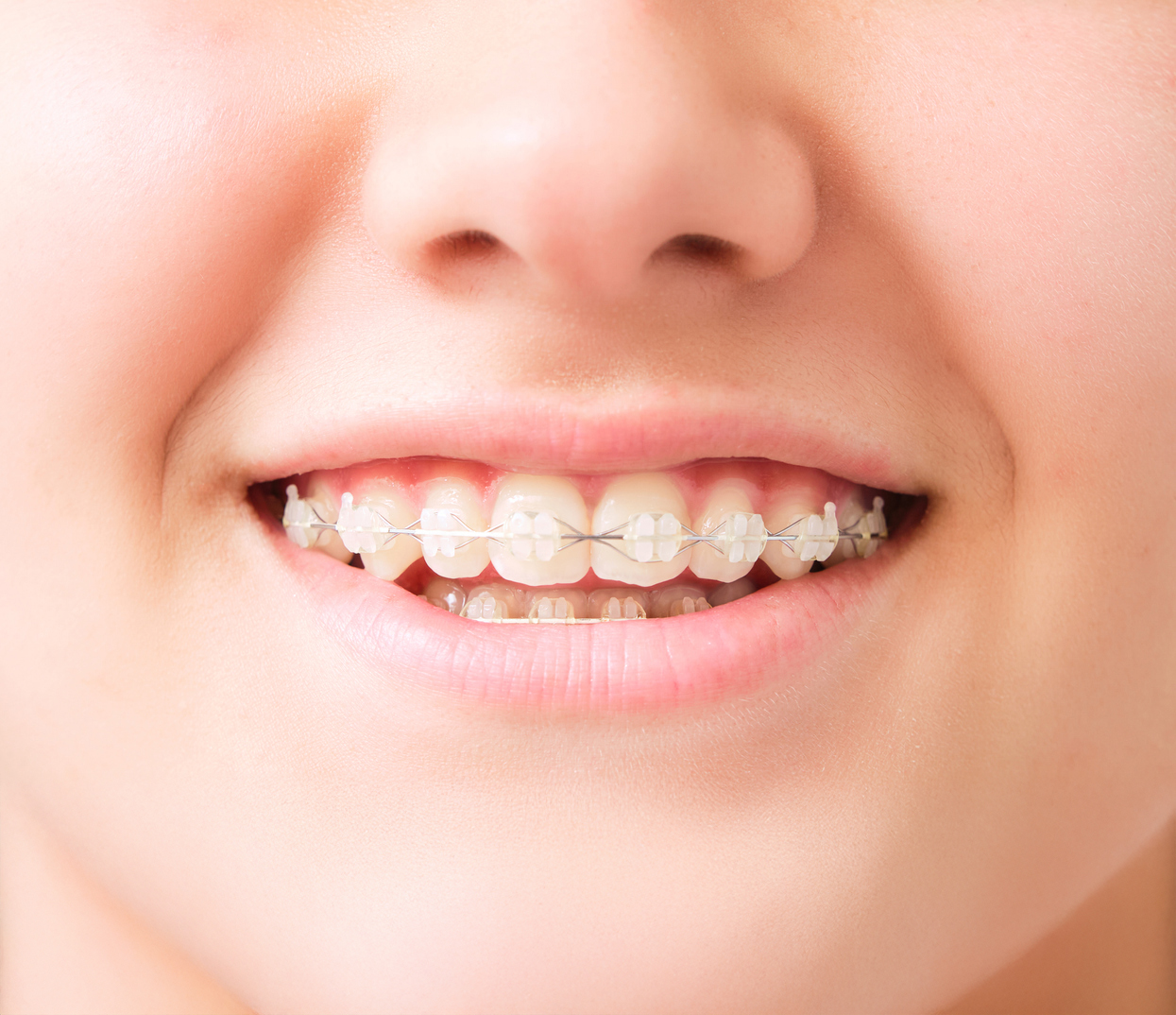 closeup of white teenage girl's mouth smiling with invisible white dental aligner