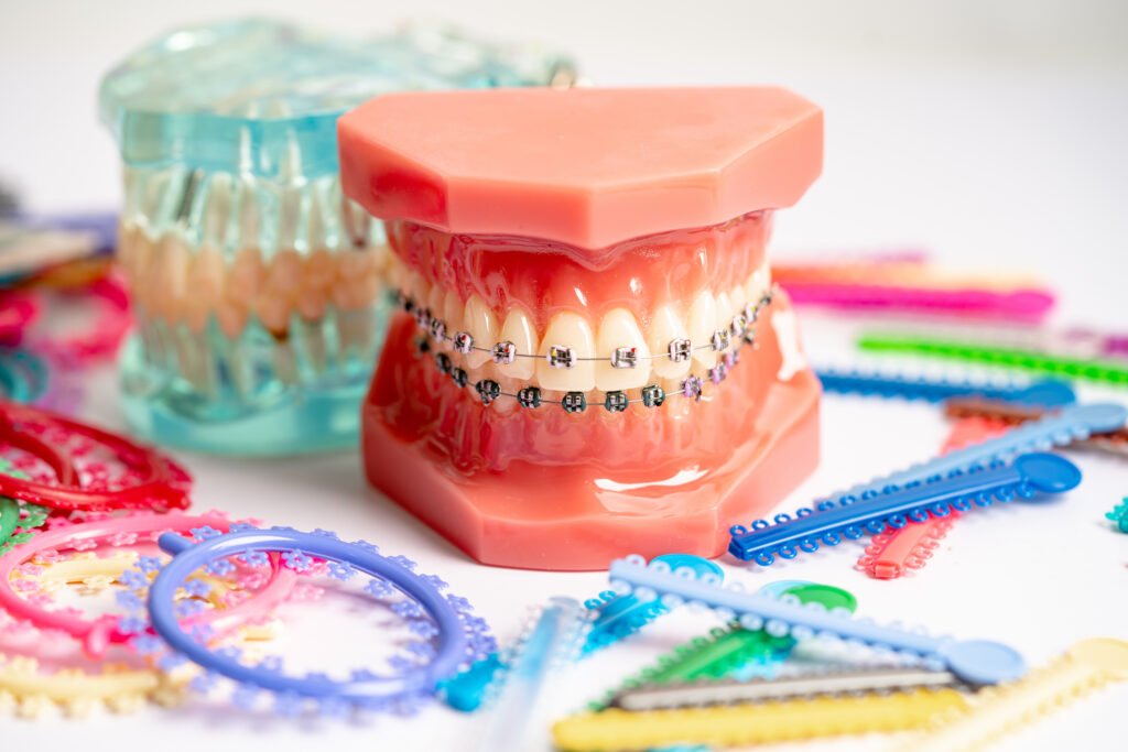 Orthodontic ligatures rings and ties, elastic rubber bands on orthodontic braces, model for dentist studying about dentistry.